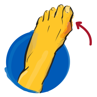 Bunions on Feet