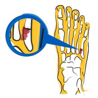 Foot and Ankle Fractures
