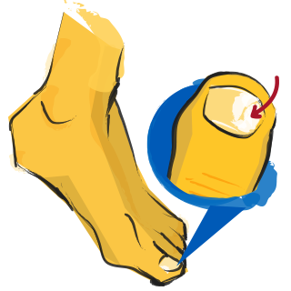 Toenail Fungus