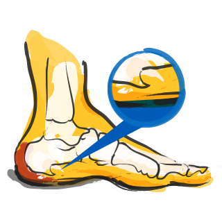 Heel Spur
