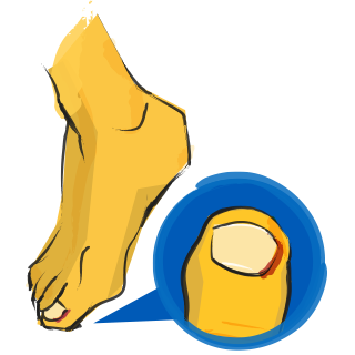Ingrown Toenails