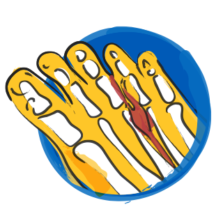 Morton's Neuroma