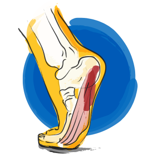 Planar Fasciitis