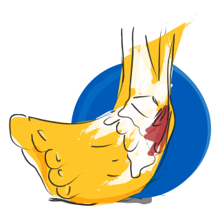 Ankle and Foot Sprains
